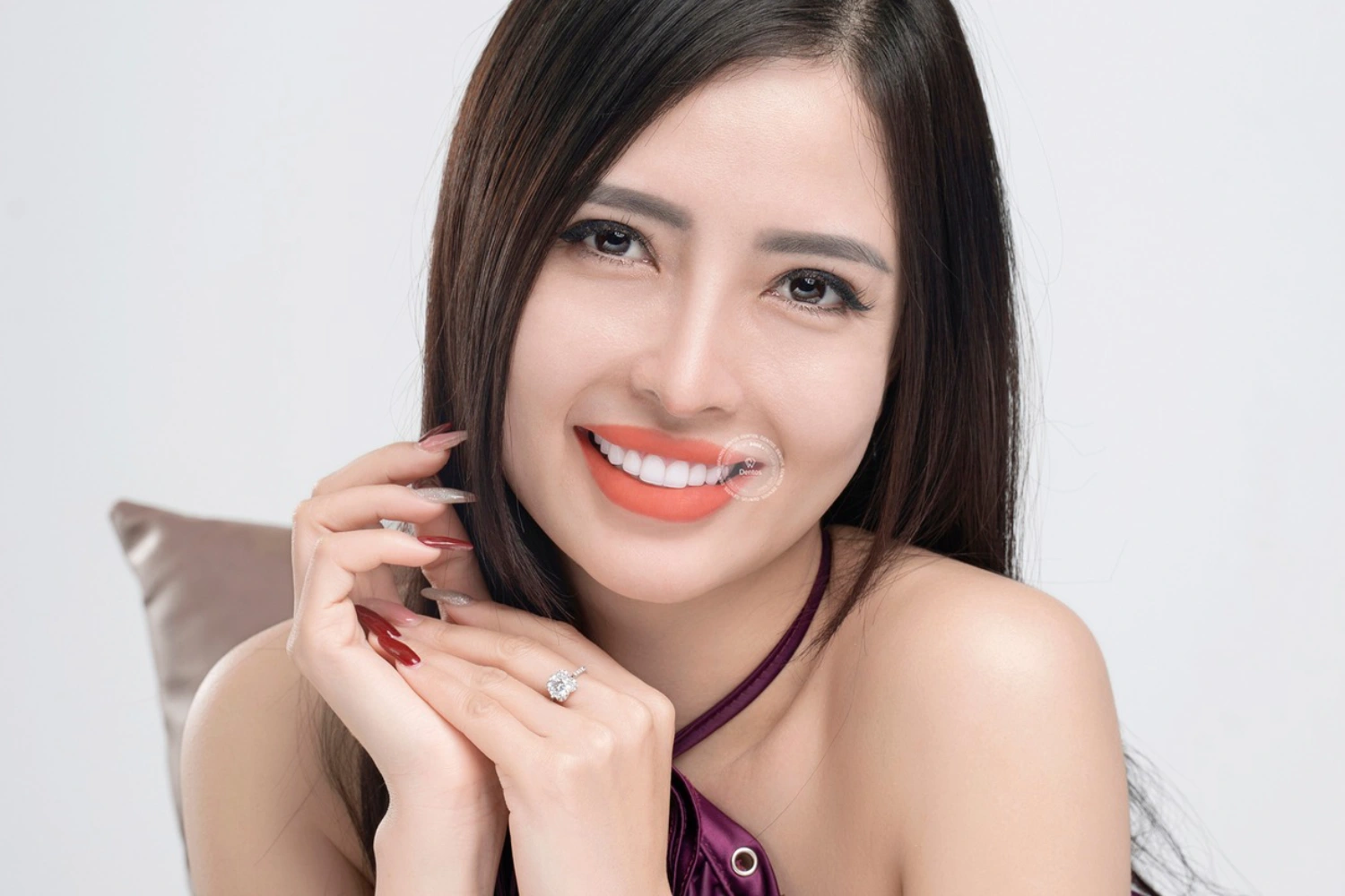 Các răng nằm trên đường cười yêu cầu tính thẩm mỹ và độ trong mờ cao